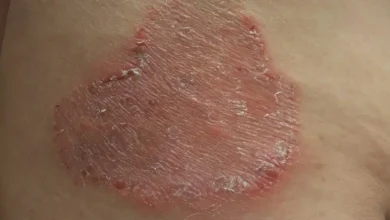 قارچ سگ در انسان