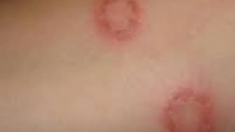 قارچ پوستی سگ به انسان